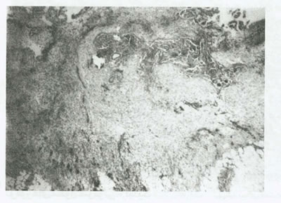 بيماريهاي تخمدان و لوله هاي رحمي چیست؟(1)